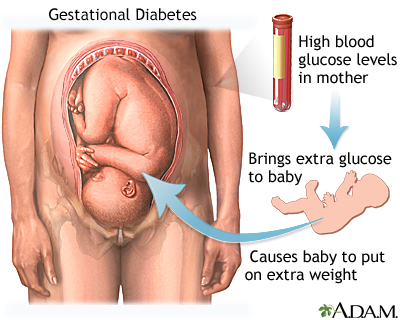 Living with Gestational Diabetes: Tips for a Healthy Pregnancy