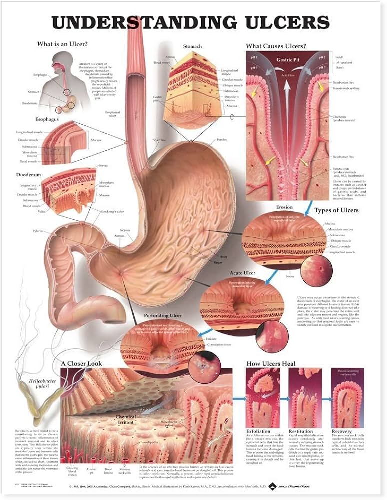 Understanding Ulcers: Types, Causes, and Symptoms