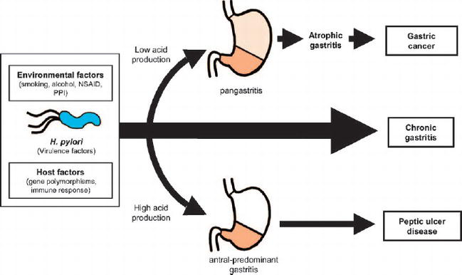 The Role of H. Pylori in Ulcer Development