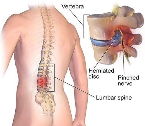 Is Surgery Necessary for Back Pain? A Guide to When and Why