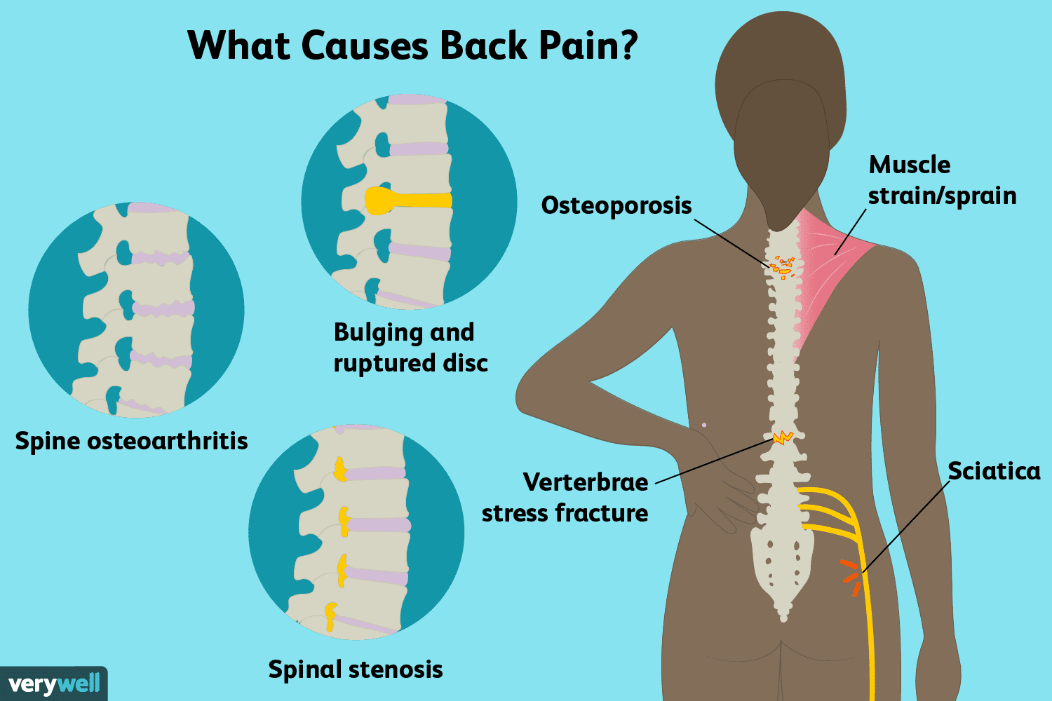 Understanding Back Pain: Causes, Types, and Symptoms