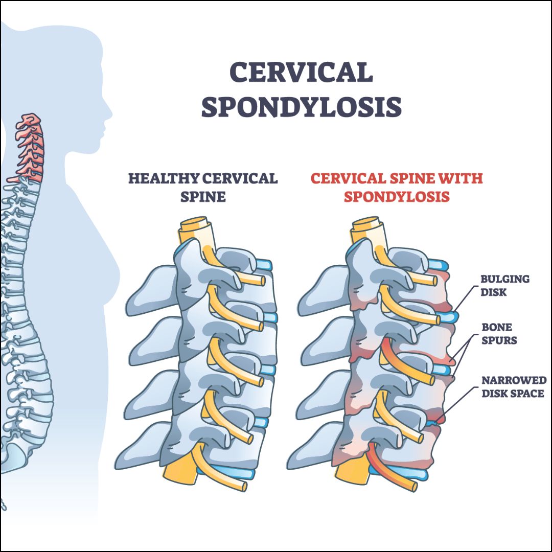 Understanding Cervical Spondylosis: A Guide to Symptoms and Treatment