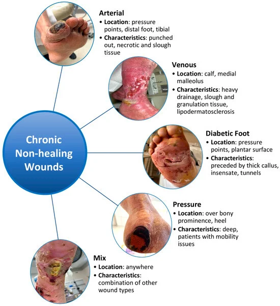 The Link Between Chronic Conditions and Ulcer Development