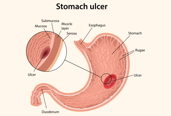 Medications for Ulcer Treatment: A Comprehensive Guide