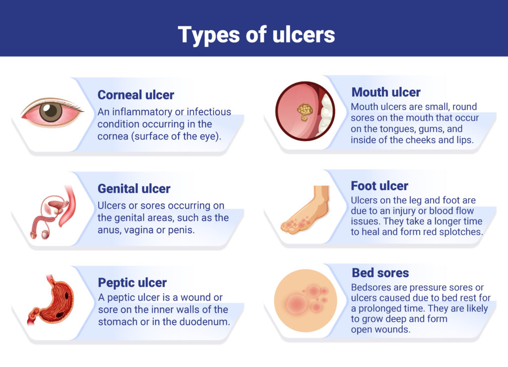 FAQs About Ulcers: Expert Answers to Common Questions